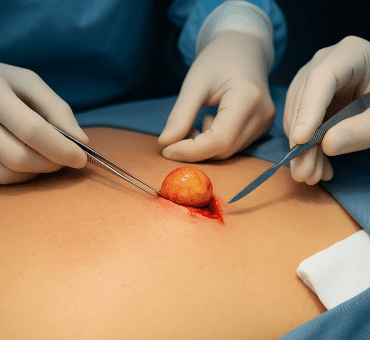 Extirpación de lipomas mediante cirugía menor