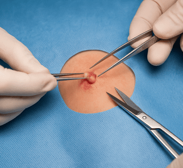 Extirpación de lesiones cutáneas benignas​