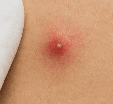 Tratamiento de vellos encarnados o foliculitis