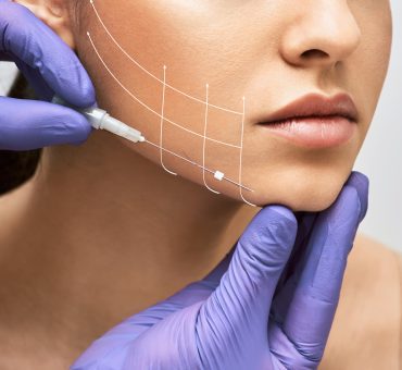 Medicina Estética - Hilos Tensores